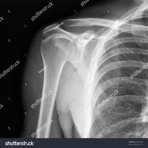 X-ray Shoulder Joint Many Others X-ray Stock Photo 76075996 | Shutterstock
