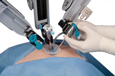 Study compares Single-Incision with standard 4-port Laparoscopic ...