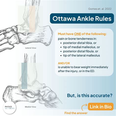 Physio Network on LinkedIn: 🦶 Heard about the Ottawa Ankle Rules? ⁠ ⁠ 👉 ...