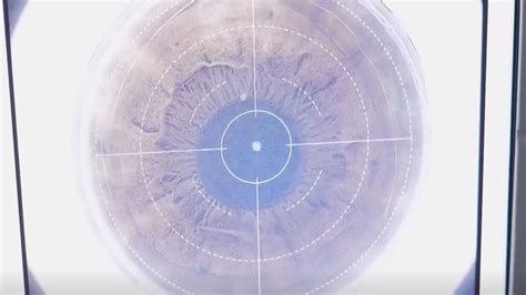 Image result for Eye Color Change Procedure