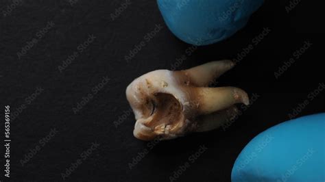Decayed Tooth Pulling 的图像结果