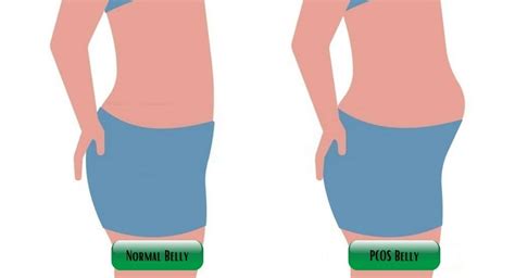 What Does a PCOS Belly Look Like? 9 Effective Tips to Reduce PCOS Belly