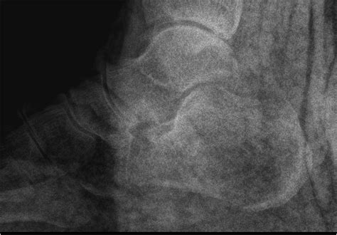 Anterior subtalar dislocation with comminuted fracture of the anterior ...