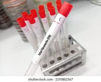 Image result for Fetal Fibronectin Test Procedure