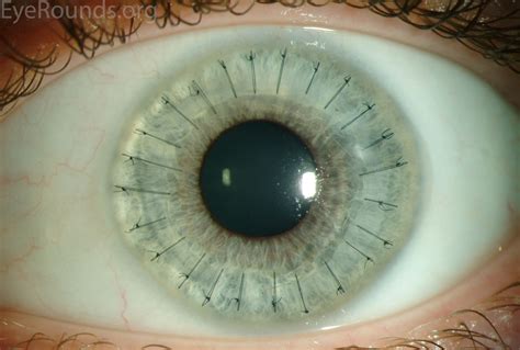Keratoconus Corneal Transplant