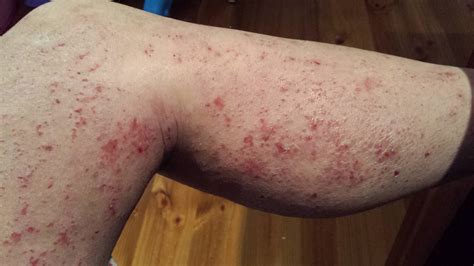 Hodgkin's Lymphoma Rash