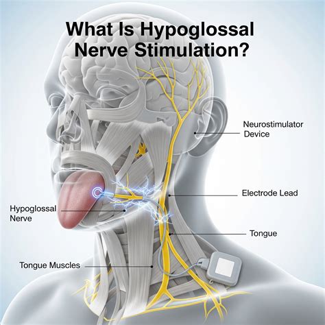 Hypoglossal Nerve Stimulation: Unlocking Its Magnificent Benefits