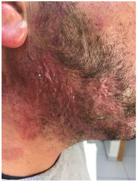 Tinea Incognito: Challenges in Diagnosis and Management