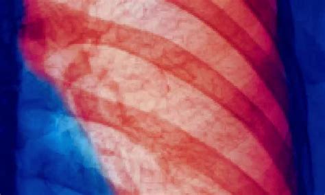 Mustard Lung Shows Elevated Oxidative Stress, Distinct from Other ...