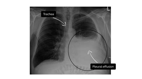 Chest X Ray Hydropneumothorax