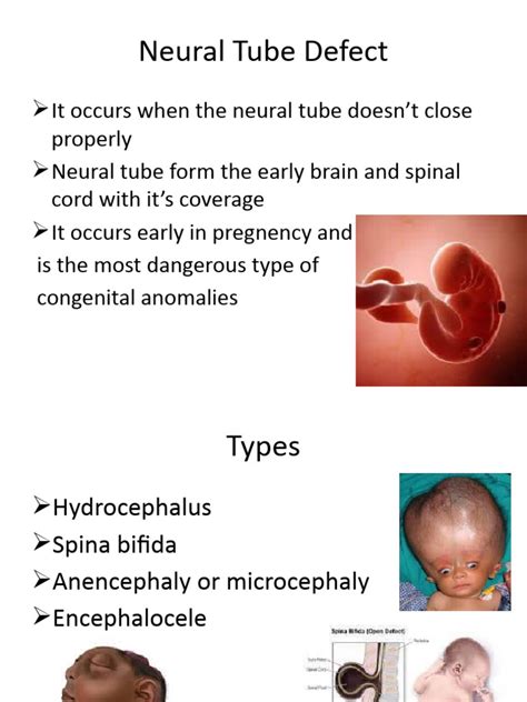 Image result for Neural Tube Defects Causes