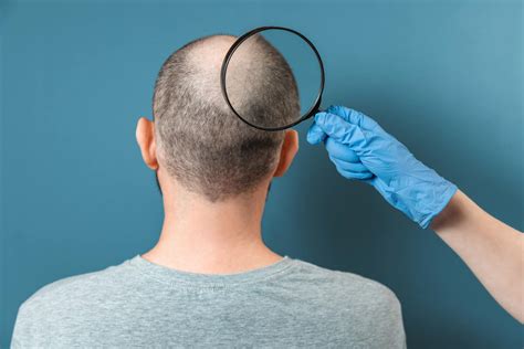 Hair Transplant in Turkey | Hair Transplant 2026 Costs