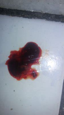 Coágulo ou aborto? | BabyCenter