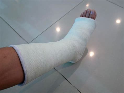 Curing Plaster Cast 的图像结果