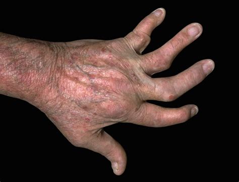 DECT Iodine Map Detects Anatomic Sites of Inflammatory Lesions in Hand Psoriatic Arthritis ...