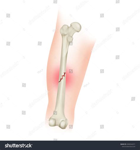 Nondisplaced Bone Fracture Femoral Shaft Fracture Stock Illustration 2000544371 | Shutterstock