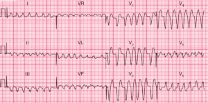 Image result for AFib Detection Algorithm