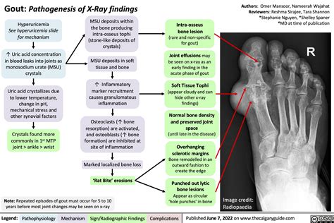 Gout Ankle Xray Chronic Tophaceous Gout MRI Sumer's Radiology Blog