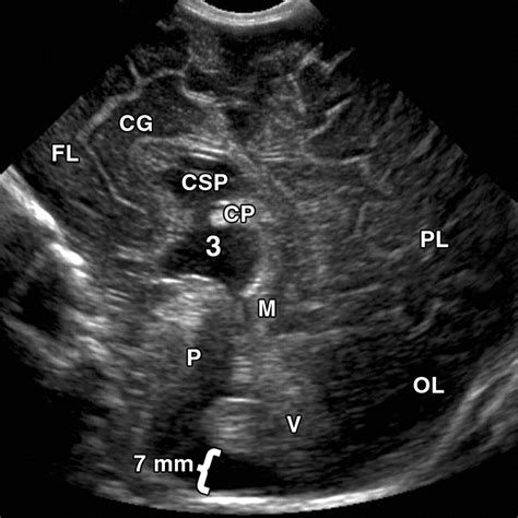 Magna Cisterna Magna Symptoms at Terry Summers blog