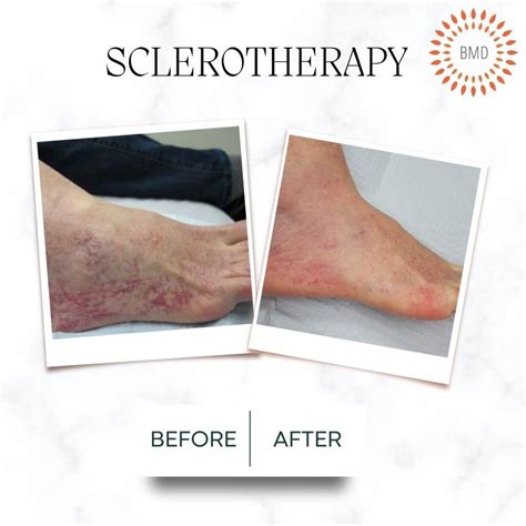 Sclerotherapy Treatment: Treating Spider Veins