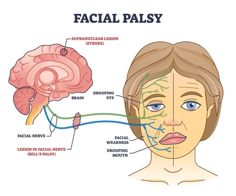 Bell's Palsy Nutrition at Zane Hodge blog