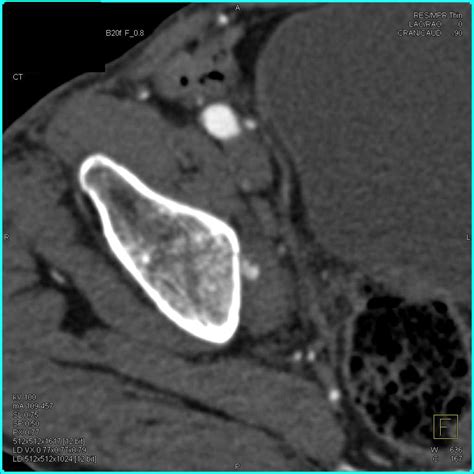 Right Hip Joint Effusion and Normal CTA - Musculoskeletal Radiology ...