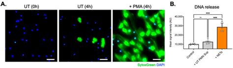 Neutrophil Extracellular Traps Affect Human Inner Ear Vascular Permeability
