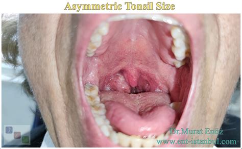Healthy Vs Unhealthy Tonsils