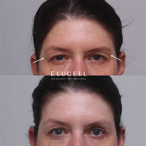 Image result for Thread Brow Lift Procedure