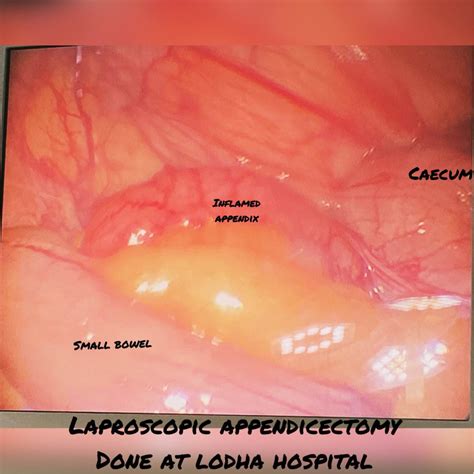 Today morning we had good morning appendix Someth