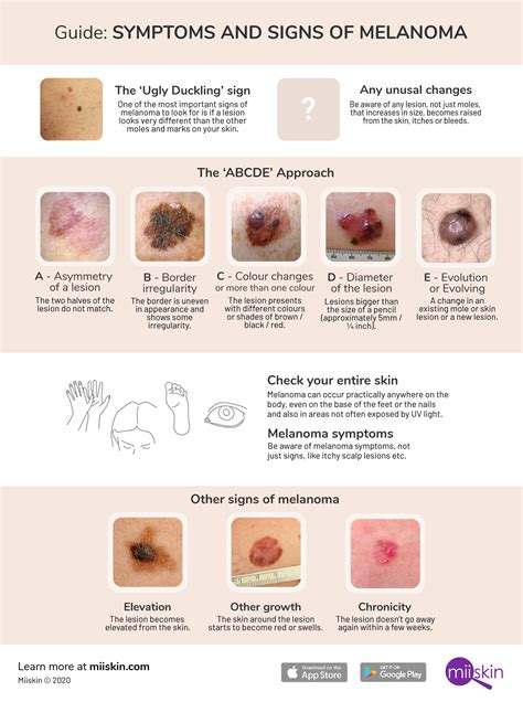 Early Melanoma Symptoms