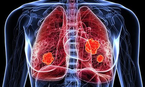 Lung Cancer in 70-Year-Old Diagnosed Through Advanced CBCT-Guided Cryo ...