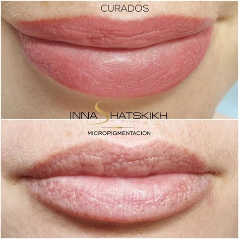 Granos De Fordyce Labios Tratamiento Casero at Keira Jeanneret blog