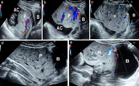 Placental lakes vs lacunae: spot the differences - Jauniaux - 2024 ...