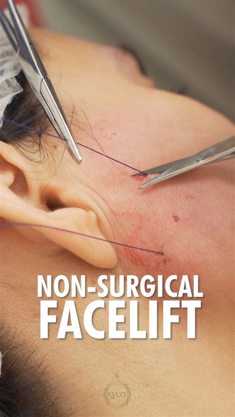 Image result for Fox Eye Thread Lift Procedure