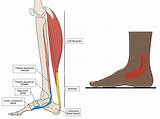 Tibialis Posterior Dysfunction (TPD) is a Pain in the 'Ankle' and 'Arch ...