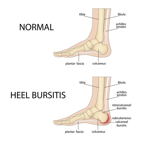 Heel Bursitis Runner's World at Zoe Szabados blog
