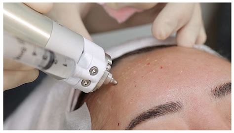 Needle-Free Jet Injection of Poly-(Lactic Acid) for Atrophic Acne Scars ...