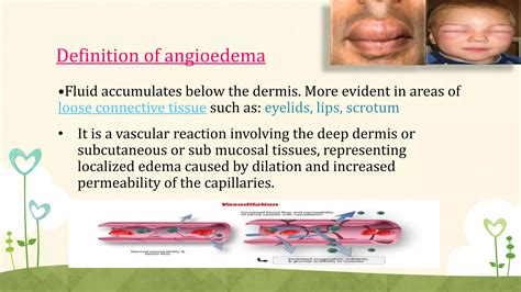 Angioedema | PPTX