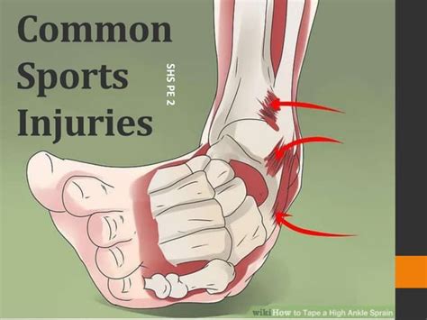 sports injuries 的图像结果