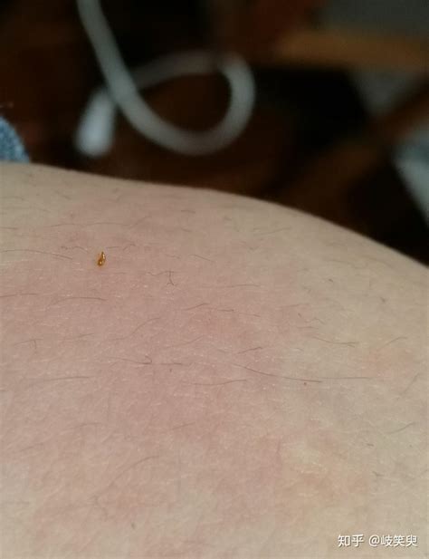 请问这是什么虫子，咬人会肿一个很痒的包。长得像蚂蚁特别小，红棕色。可以蜷起来，还会装死? - 知乎