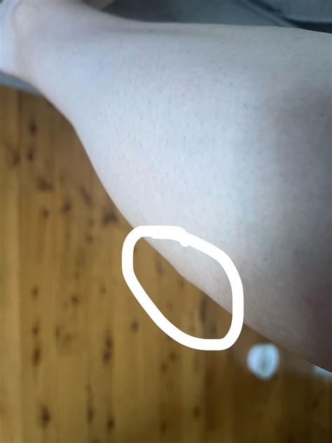Soft lump on leg : r/Lipoma