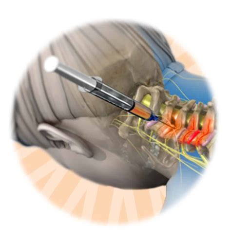 Medial Branch Block Injection Procedure in Minnesota