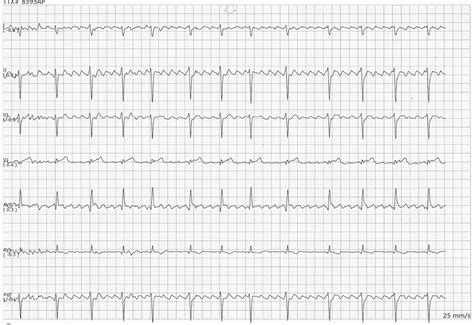 Icd 10 atrial flutter - boolmaximum