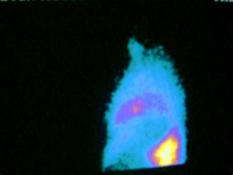 Image result for Muga Scan Lab Results