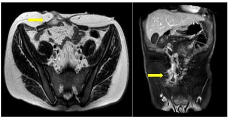 Bowel Perforation in Vascular Ehlers–Danlos Syndrome: Case Report and ...