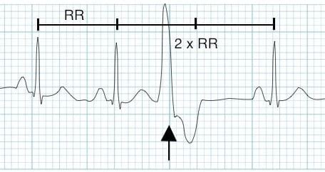Understanding ECG features of ectopic heartbeats