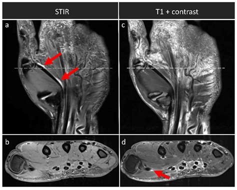 To Contrast or Not to Contrast? On the Role of Contrast Enhancement in Hand MRI Studies of ...