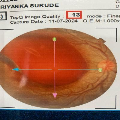 Latest News - Retina Eye Care Clinic,Nashik