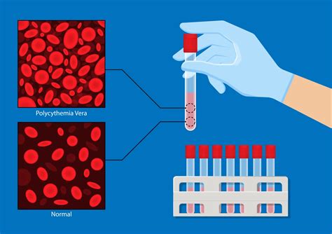 What is Polycythemia Vera - MPN Cancer Connection